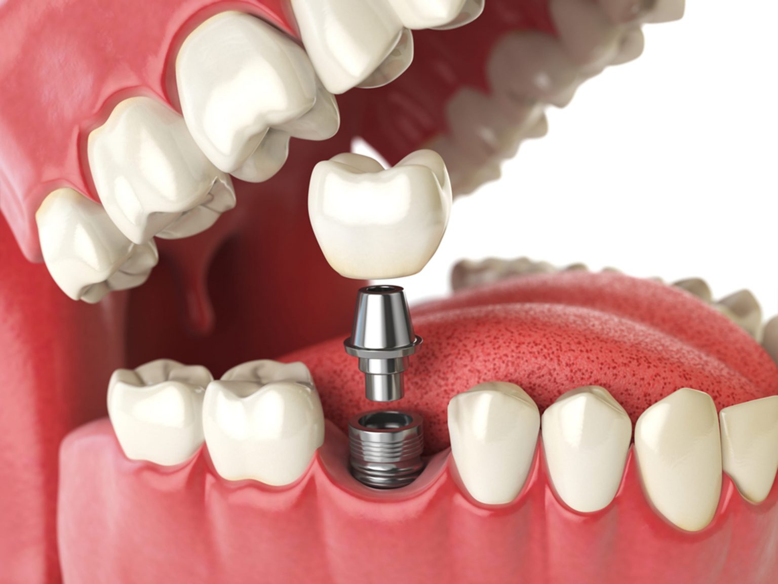 Beyond Aesthetics: The Health Benefits of Dental Implants